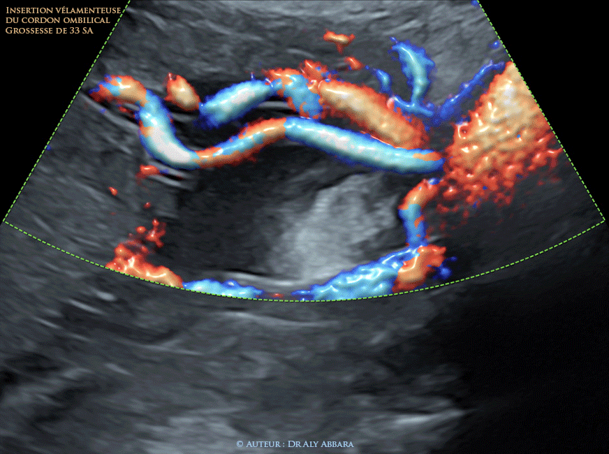 Insertion vélamenteuse (en parapluie) du cordon ombilical - grossesse de 22 SA