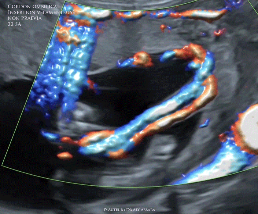Insertion vélamenteuse (en parapluie) du cordon ombilical - grossesse de 22 SA