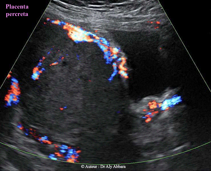 Placenta antérieur praevia et accreta de type percreta