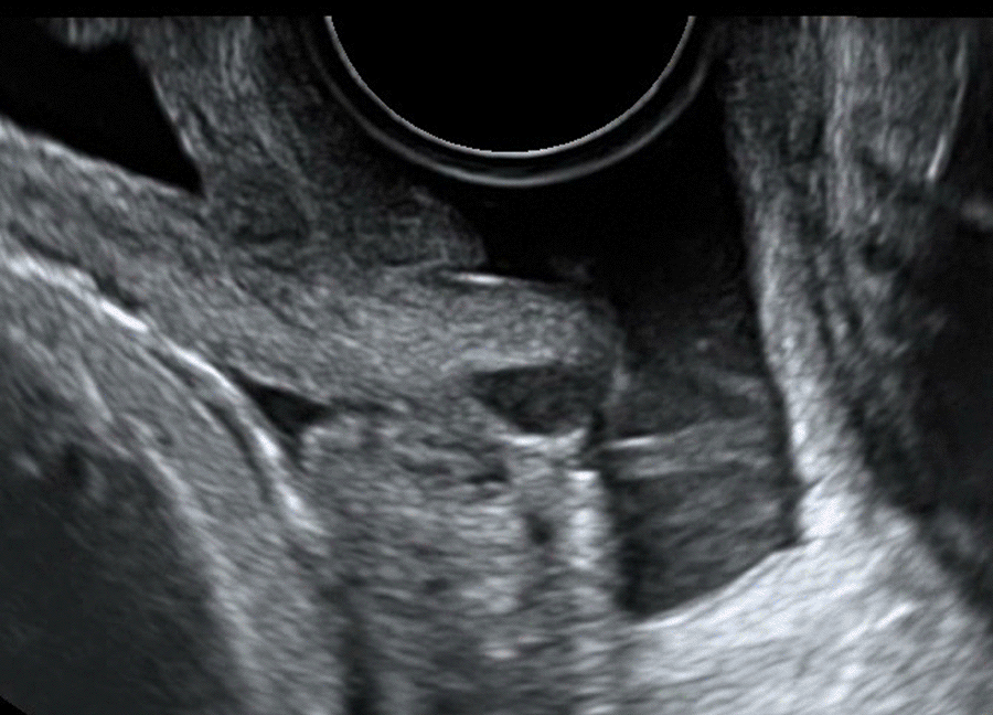 Écoulement en jet du liquide amniotique dans le vagin à travers le canal du col utérin : grossesse de 34 SA avec rupture prématurée des membranes amniotiques