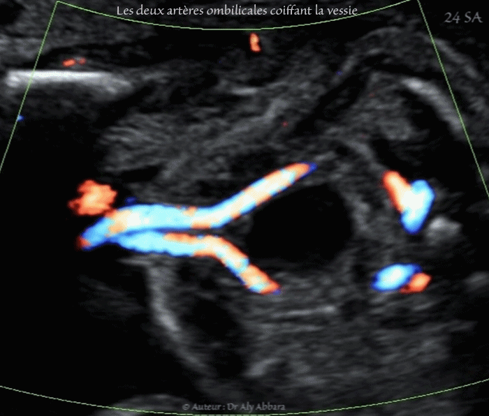 Artères ombilicales au cours de la vie foetale - trajet pelvien