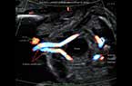 Artères ombilicales au cours de la vie foetale - trajet pelvien coiffant la vessie - 24 SA
