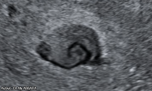Caverne placentaire : aspect échographique sans Doppler couleur - tourbillons sanguins