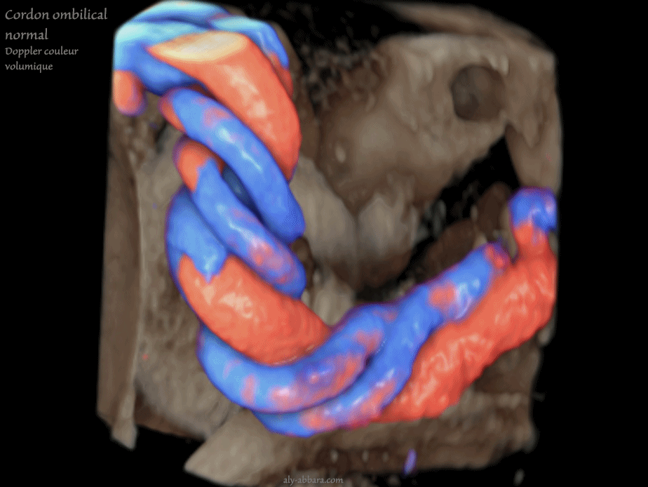 Cordon ombilical normal - Doppler couleur volumique
