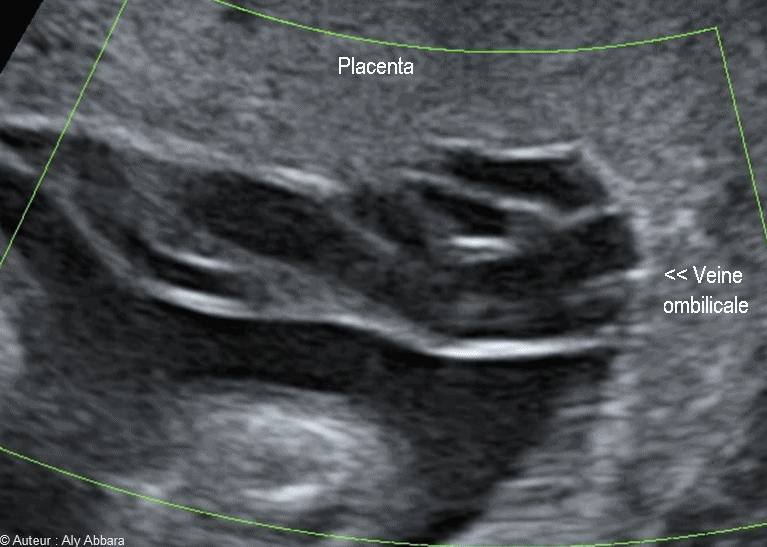 Le flux sanguin dans la veine ombilicale naissant du bord du placenta - الدوران الدموي داخل الوريد السري إبتدأً من منشأه من المشيمة