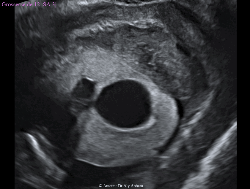 Kyste cytotrophoblastique itraparenchymateux (intraplacentaire) associé à la présence d'un hématome rétroplacentaire - grossesse de 12 SA et 3J