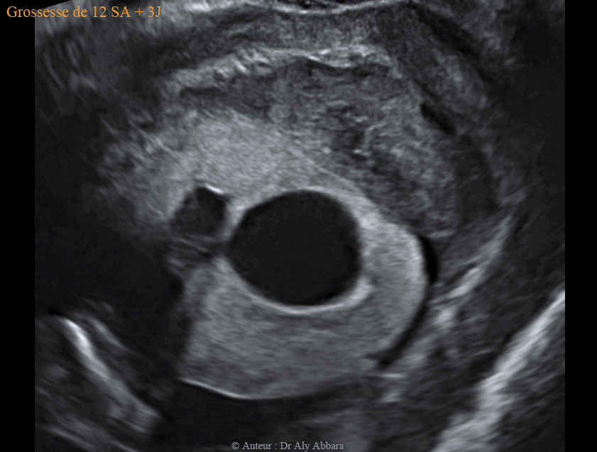 Kyste cytotrophoblastique intra-parenchymateux