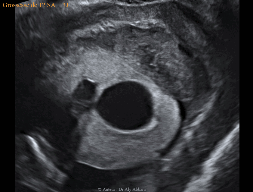 Kyste cytotrophoblastique intra-parenchymateux