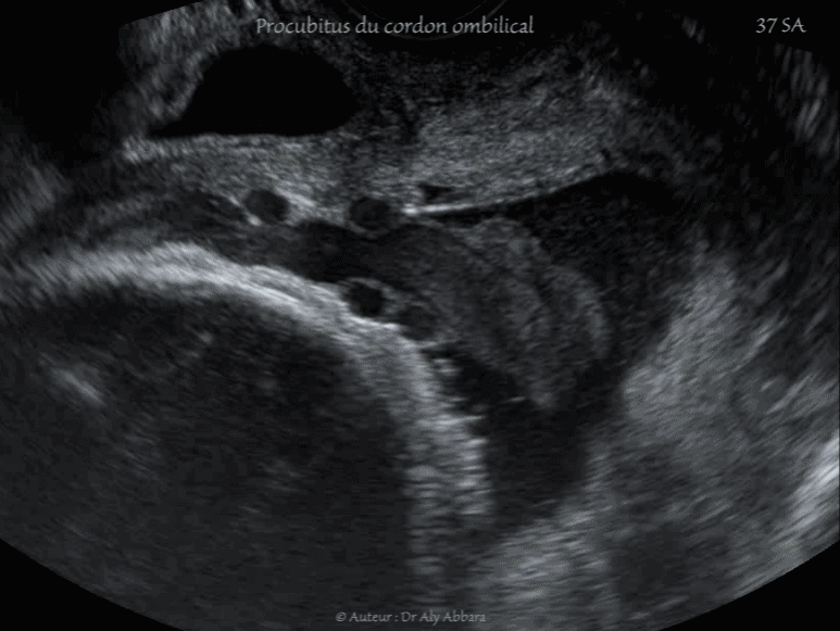Procubitus du cordon ombilical - Grossesse de 37 SA