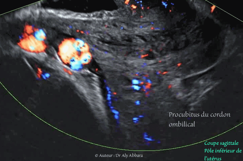 Varice proximale de la veine ombilicale intra-abdominale  - دوالي الوريد السري داخل بطن الجنين
