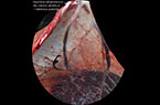 Vasa praevia associé à une insertion vélamenteuse du cordon ombilical