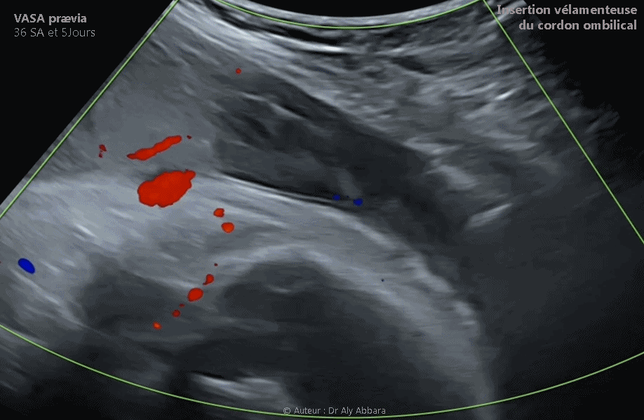Vaisseaux praevia associés à une insertion vélamenteuse du cordon - grossesse de 36 SA