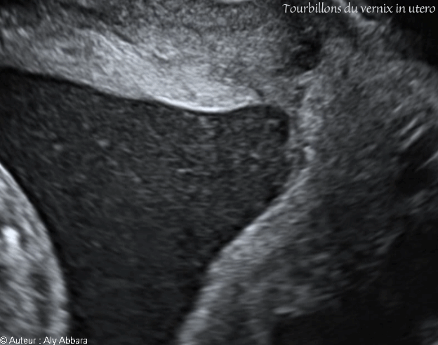 Fraquements de vernix tourbillonnant dans le liquide amniotique - الطلاء الدهني الجنيني العالق والمتحرك في السائل الأمنيوسي