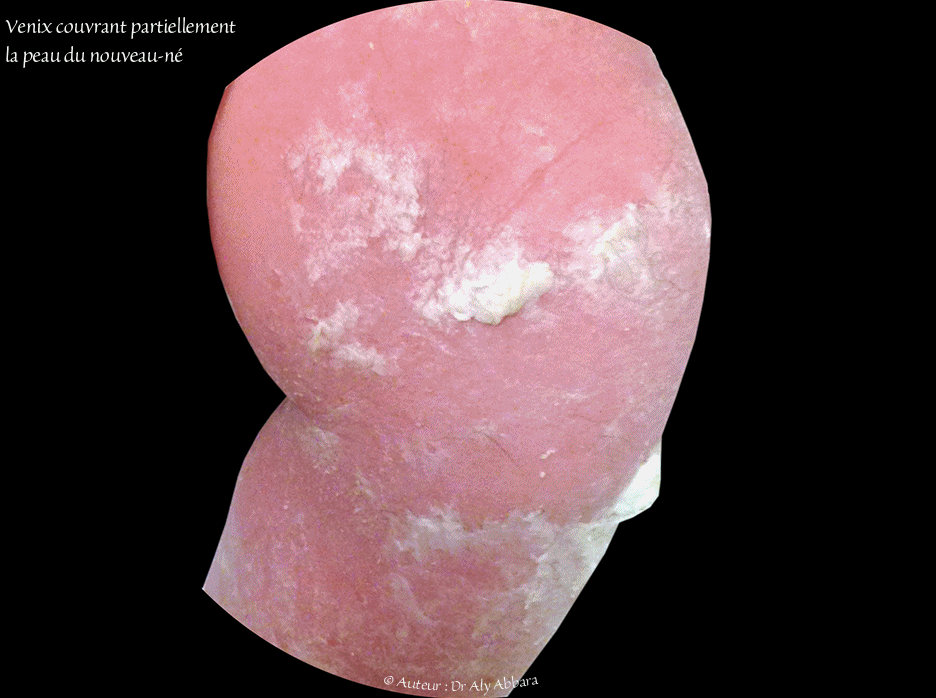 Vernix caseosa - الطلاء الدهني الجنيني