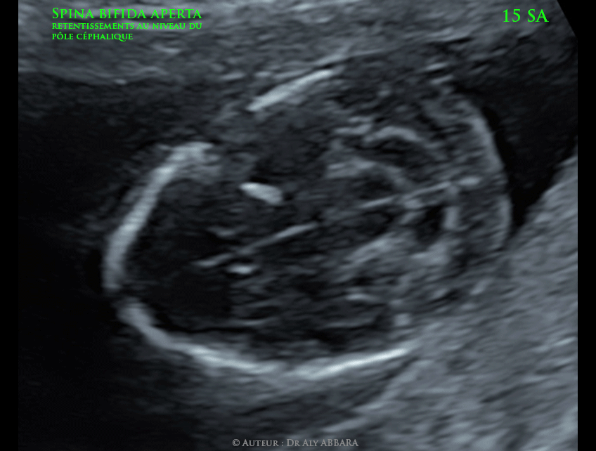 Signe observables au niveau du pôle céphalique en cas de spina bifida