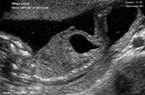 Mégavessie dans le cadre d'une valve urétrale postérieure - Foets du sexe masculin âgé de 15 SA