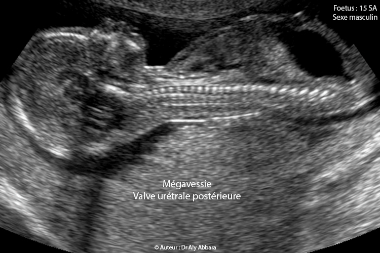 Mégavessie dans le cadre de la présence d'une valve de l'urètre postérieure - Foetus de 15 SA, du sexe masculin