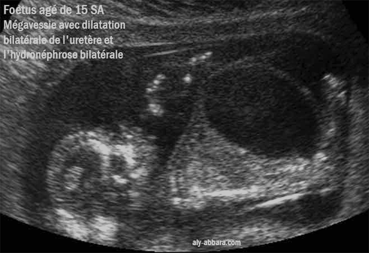 Megavessie importante à 15 SA (Syndrome de Prune Belly)