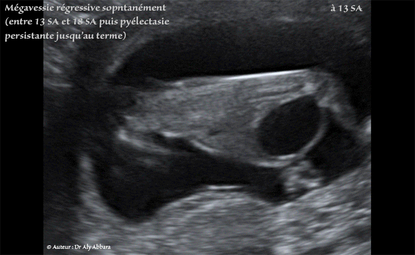 Mégavessie régressive spontanément entre 13 et 18 SA - Pyélectasie rénale bilatérale progressive - Foetus du sexe masculin
