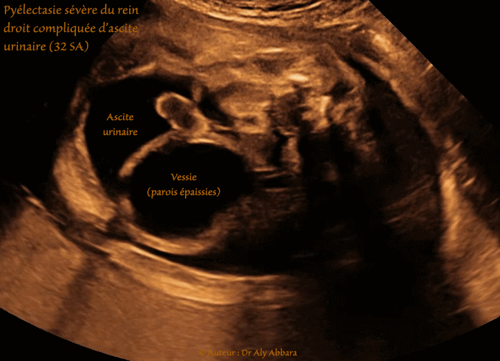 Kyste cytotrophoblastique intra-parenchymateux