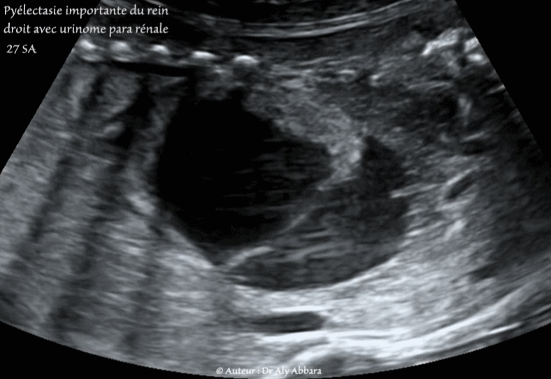 Kyste cytotrophoblastique intra-parenchymateux