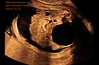 Pyélectasie sévère du rein droit compliquée par la formation d'un urinome puis une ascite urinaire - foetus âgé de 32 SA
