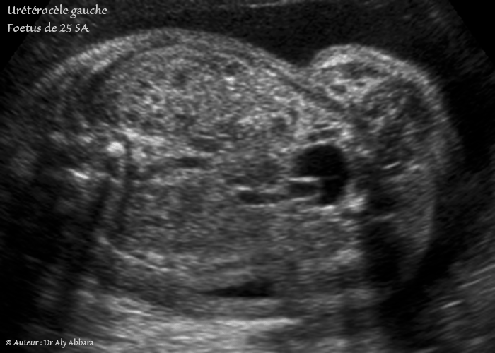 Urétérocèle - Définition, classification, descriptions - Un cas chez un foetus de 25 SA du sexe masculin