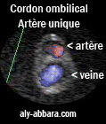 Cordon ombilical avec artère ombilicale unique pulsative