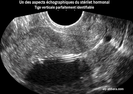 Stérilet hormonal : un de ses aspects échographique : tige verticale parfaitement identifiable