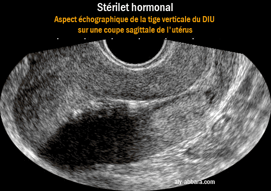 Image montrant l'un des aspects de la tige verticale du stérilet hormonal avec la formation d'un cône d'ombre lors du passage des ondes ultrsonors