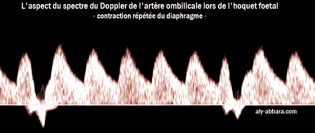 Image montrat les modifications de l'aspect du spectre de l'artère ombilicale  lors des mouvements de l'hoquet