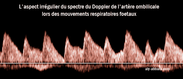 Les modifications de l'aspect du spectre de l'artère ombilicale au cours des mouvements respiratoires foetales