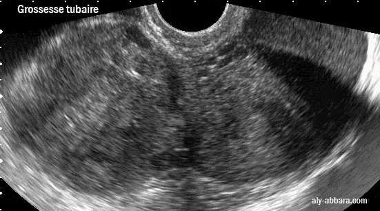 Grossesse extra-utérine avec un géant hématosalpinx, dans un contexte de salpingite chronique 