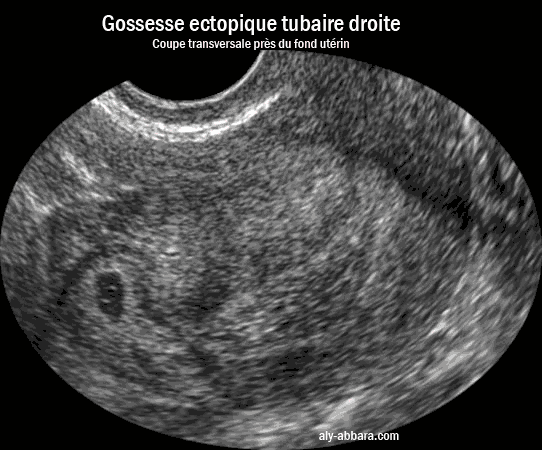 Grossesse extra-utérine dans la portion tubaire interstitielle droite