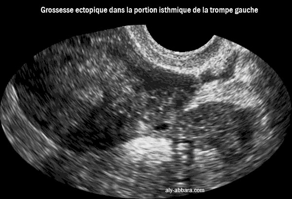 Grossesse extra-utérine tubaire isthmique
