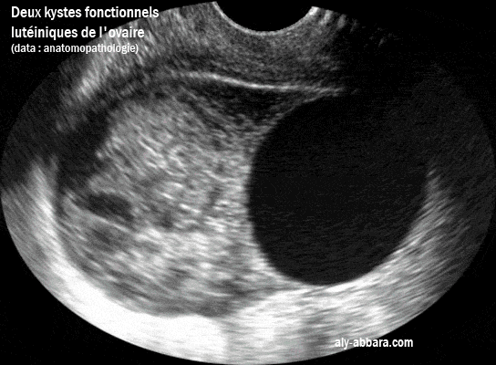 Deux kystes lutéiniques de l'ovaire gauche dont un avec une hémorragie intra-kystique
