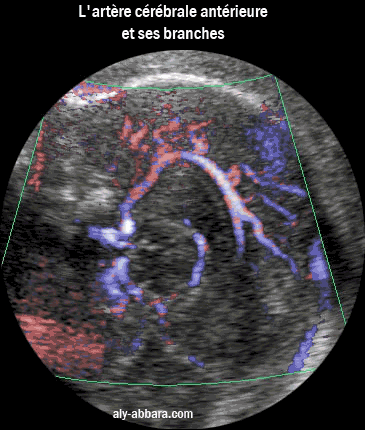 Artère cérébrale antérieure et ses branches