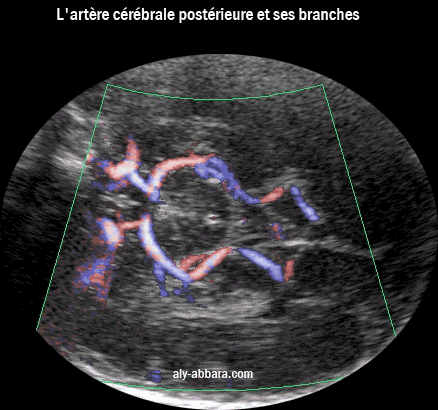 L'artère cérébrale postérieure et sa branche interne pricipale, l'artère calcarine