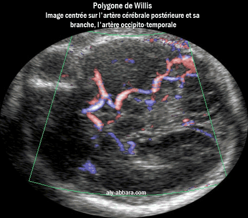 L'artère cérébrale postérieure et sa branche occipito-temporale