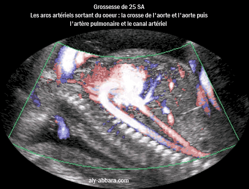 Image échographique avec le Doppler Dynamic Flow montrant les arcs artériels sortant du coeur foetal : crosse de l'aorte et l'aorte puis l'artère pulomnaire avec son canal artériel communicat avec l'aorte