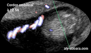 Cordon ombilical  : il est composé d'une veine enroulée par deux artères