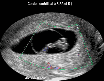 Image échographique montrant l'aspect du cordon ombilical à 9 SA