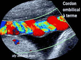 Le cordon ombilcal à terme : les deux artères et la veine