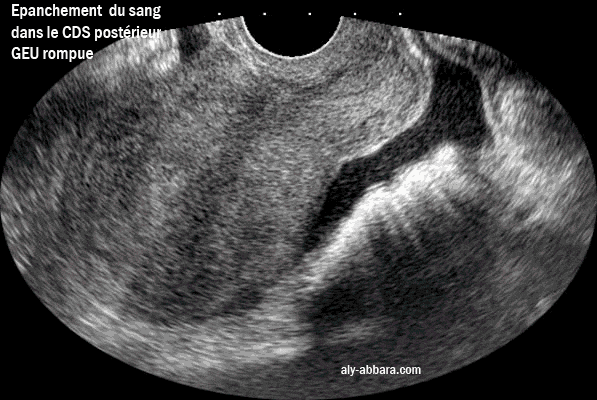 Epanchement du sang dans le cul-de-sac postérieur (de Douglas) dans le cadre d'une grossesse extra-utérine rompue