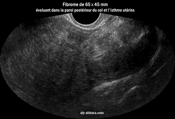 Image échographique montrant un myome se développant au niveau de la paroi postéieure du col utérin et l'isthme