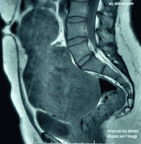 Utérus polymyomateux très volumineux