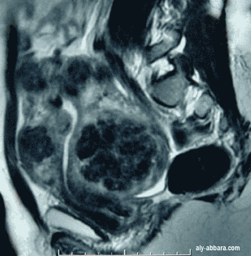 Utérus très volumineux porteur de multiple fibrome interstitiels de taille très variables 