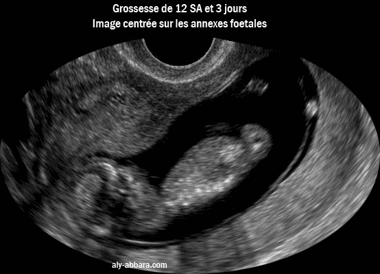 Image échographique montrant le devenir du sac vitellin secondaire (vésicule ombilicale)