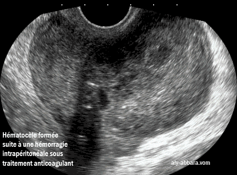 Hematocèle ou uh hématome organisé dans le cul-de-sac postérieur (de Douglas)