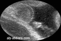 Foetus du sexe masculin à 36 SA, en miction urinaire